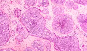 Verzenio&reg; Significantly Reduced the Risk of Cancer Recurrence by 25% for People with HR+, HER2- High Risk Early Breast Cancer