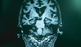 Nueva terapia podría evitar el deterioro cognitivo en adultos mayores