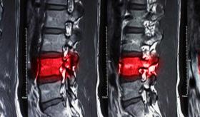 La estimulación de la médula espinal alivia la neuropatía diabética dolorosa