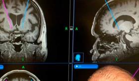 Prueban un implante cerebral para controlar la adicción al alcohol