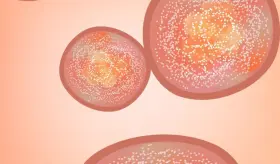 Relacionan la psoriasis con enfermedades cardíacas en puertorriqueños