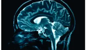 Identifican grupo de pacientes diferenciado dentro de la esquizofrenia