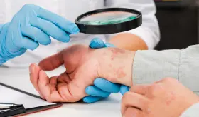 Tratamientos efectivos contra la psoriasis