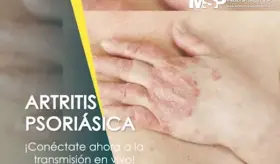 Artritis psoriásica