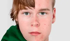 Factores que contribuyen con la pubertad precoz