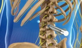 Cuestionan la utilidad de los bloqueos paravertebrales como tratamiento del dolor crónico