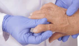 Baricitinib y tofacitinib podrían ser efectivos en tratamiento clínico contra la artritis reumatoide