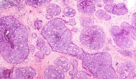 La pandemia de COVID-19: el tratamiento a pacientes con cáncer de mama en todo el mundo