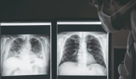 Jóvenes con obesidad presentarían exacerbación de síntomas respiratorios por COVID-19, según estudio