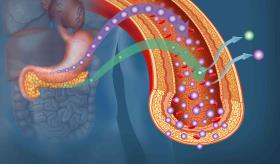 ¿Qué tan común es la remisión de pacientes con diabetes tipo 2?