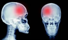 Existe un alto riesgo de epilepsia 1 año después del accidente cerebrovascular, según estudio