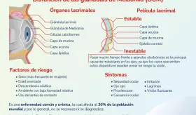 Síndrome del Ojo Seco - Infografía
