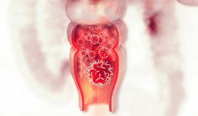 Adultos jóvenes con sobrepeso u obesidad tienen mayor riesgo de padecer cáncer colorrectal