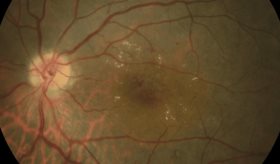 Conoce qué es el edema macular diabético y cómo prevenirlo