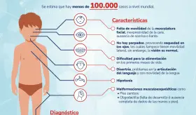 S&iacute;ndrome de Moebius - Infograf&iacute;a