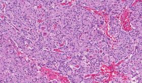 Síntomas del cáncer de páncreas: causas y tratamiento