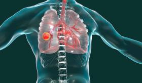 Síntomas del cáncer de pulmón, uno de los tumores más mortales