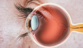 Cánceres retinianos, tipos de cáncer poco comúnes que generan visión borrosa y destellos de luz