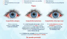Conjuntivitis - Infografía