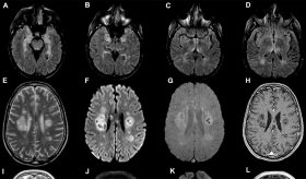 Más evidencia: la niebla mental de Covid-19 tiene base neurológica