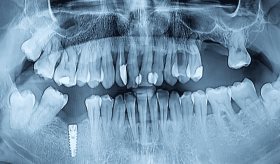 Enfermedades sistémicas y periodontitis: así se relacionan