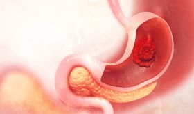 Úlceras en el estómago: causas, síntomas y tratamiento