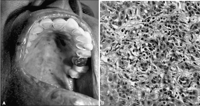 Erosiones dentales en paciente con historial de alcoholismo por hepatitis autoinmune