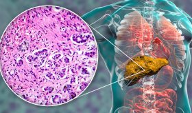 Analgésicos ¿La única opción para el dolor crónico en la cirrosis?