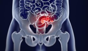 Investigadores determinan tratamiento evitando secuelas permanentes de cáncer rectal