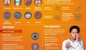 Sindrome de Sjögren - Infografía