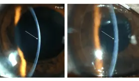 Desarrollan córnea de bioingeniería que devuelve la vista a personas ciegas y con deficiencias visuales