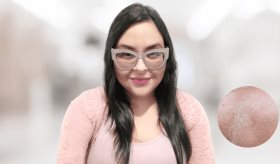 "La actitud positiva es fundamental cuando se padece de dermatitis atópica", afirma paciente