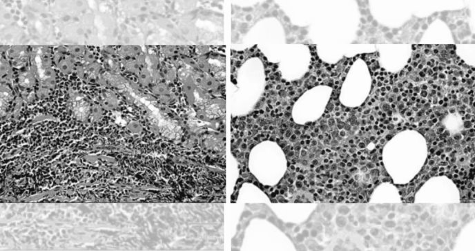Descubren linfoma MALT gástrico en médula ósea con apariencia de mieloma