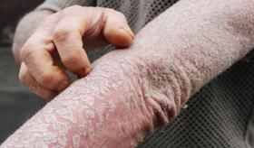Inhibidores de necrosis tumoral aumentan el riesgo de psoriasis en pacientes con artritis reumatoide