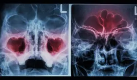 Reconozca los síntomas de la sinusitis y sus diferencias frente a la congestión nasal común