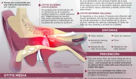 La otitis - Infografía
