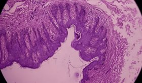 Investigadores proponen un método no invasivo para tratar la endometriosis