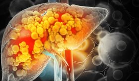 Así se manifiesta la Enfermedad del hígado graso no alcohólica (EHGNA)