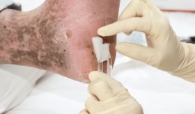 Úlceras y pie diabético siguen siendo una preocupación en la diabetes mellitus