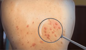 Aviso: Mujeres cis se infectaron con viruela del mono sin contacto sexual