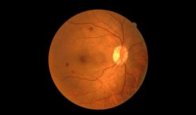 Retinopatía diabética en pacientes con diabetes tipo 2 recién diagnosticada
