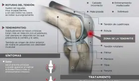 Tendón Rotuliano - Infografía