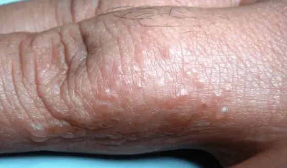 Dishidrosis o eczema dishidrótico: las ampollas que aparecen en la piel sin causa conocida