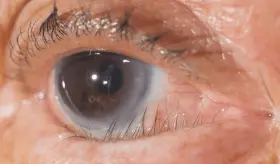 Triquiasis palpebral: lo que sucede cuando las pestañas crecen hacia el interior del ojo