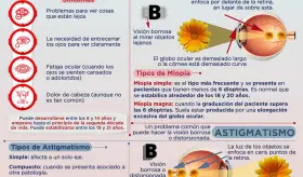 Miopía y astigmatismo - Infografía