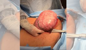 Niña de 12 años es diagnosticada con un tumor de células de la granulosa juvenil en el ovario