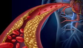 El colesterol HDL o bueno, no siempre beneficia a la salud del corazón