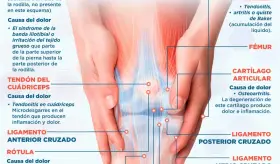 Qué punto de la rodilla duele y a qué se debe - Infografía