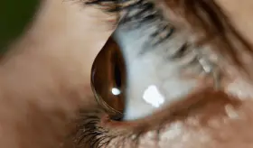 Cuidado con la frotación excesiva en los ojos, podría desarrollar queratocono sin darse cuenta