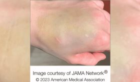 Extraño moretón verde azulado en la mano resulta ser un raro tumor de crecimiento lento